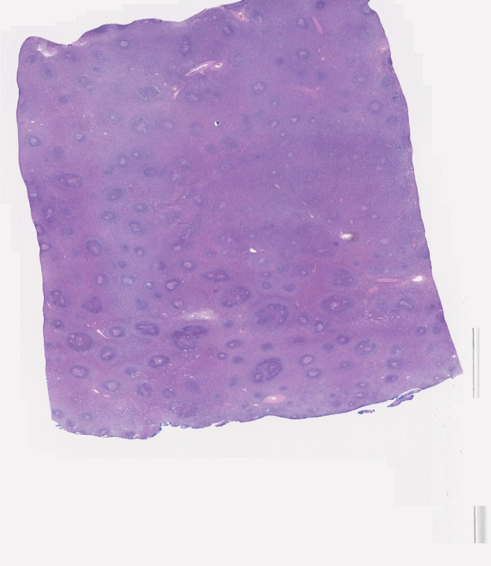 Castleman Disease Slide