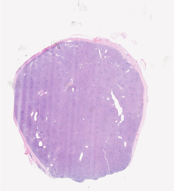 Castleman Disease Slide