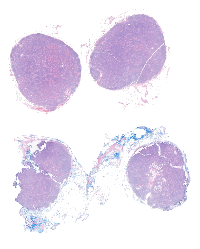 Castleman Disease Slide