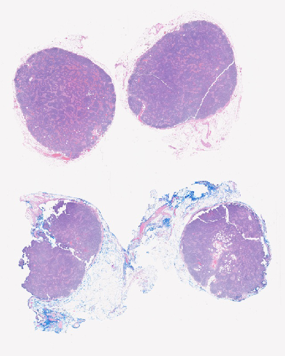 Castleman Disease Slide
